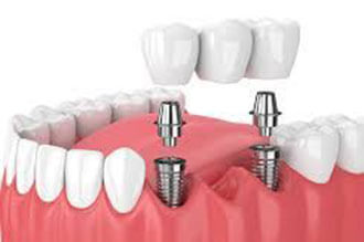 Antalya Dental Implant Treatments