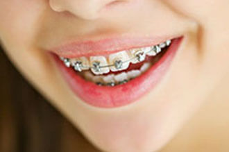 Orthodontic (Braces) Treatments