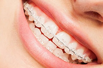 Antalya Wire Orthodontics