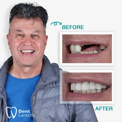 Before & after Dental Implant