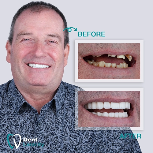 All on 6 dental implant