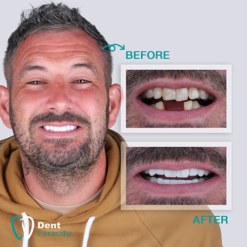 Before & after Dental Implant