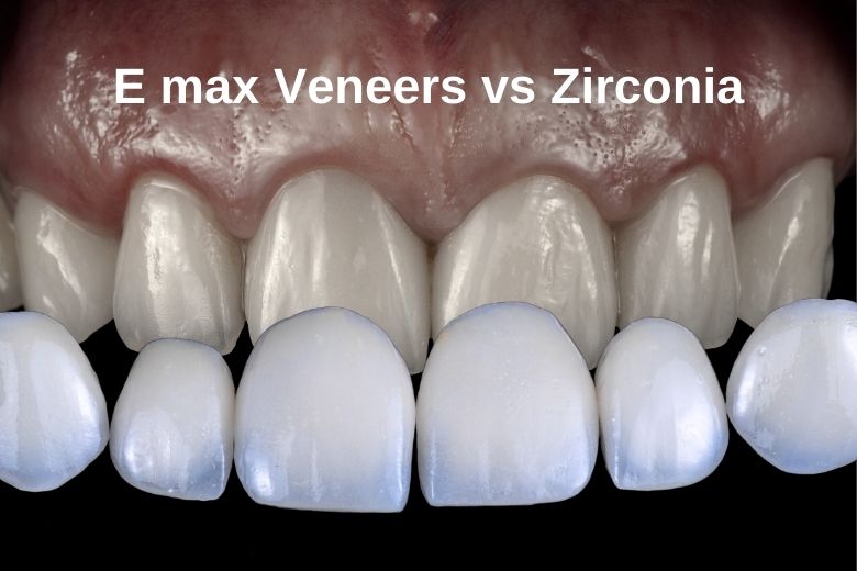 E max Veneers vs Zirconia: Which is the Best Option for You?