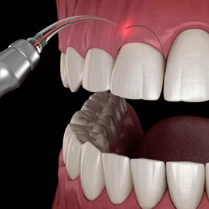 What is Tooth Reshaping?