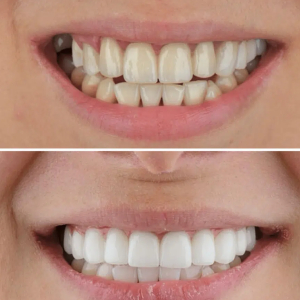 Can Old Dental Crowns Be Replaced?