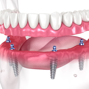 What is Full Mouth Implant Treatment?