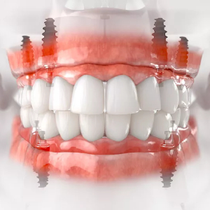 What Should Be Considered in Upper and Lower Jaw Implants?