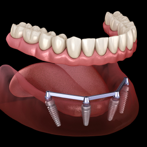 Permanent Solution for Patients Without Teeth