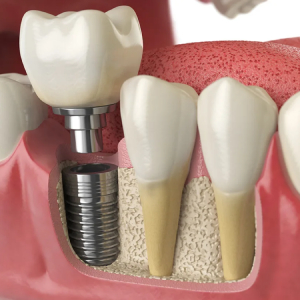 When Is An Implant Placed In Place Of An Extracted Tooth?