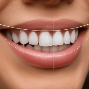 Will My Teeth Look Natural After Smile Design?