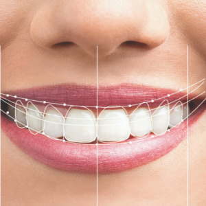 What is Smile Design?