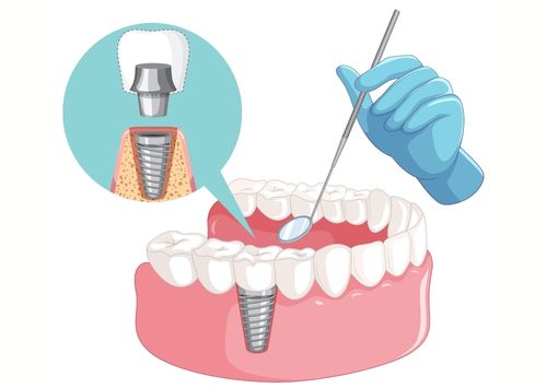 Implant Treatment