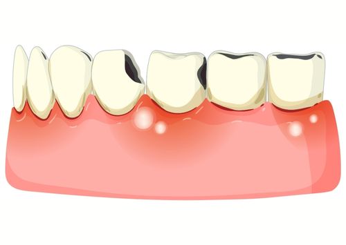 Treatment of Gum Diseases