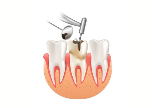 Filling Treatment